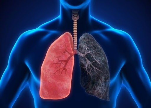 Bệnh phổi tắc nghẽn mạn tính:  Nguyên nhân, triệu chứng và cách chẩn đoán