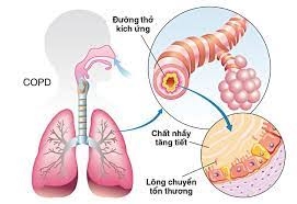 Đo thông khí phổi và làm test hồi phục phế quản