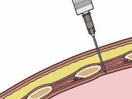 Sinh thiết màng phổi mù